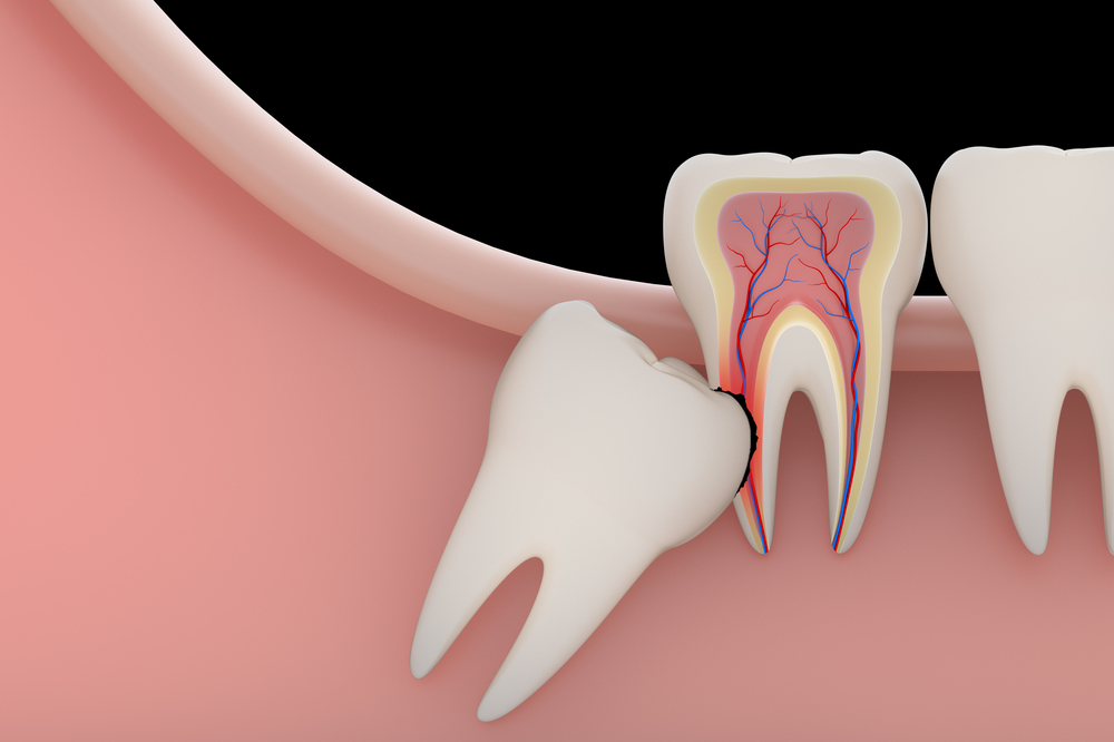 Does Wisdom Teeth Impact Cause Sinus Problems