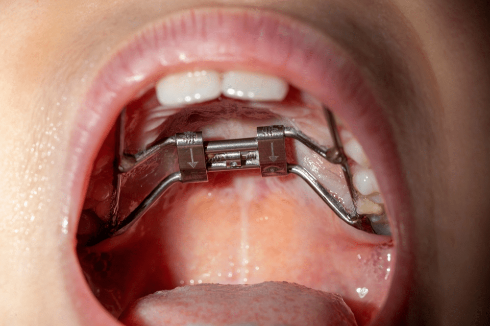 The Complete Guide to Orthodontic Palatal Expanders-