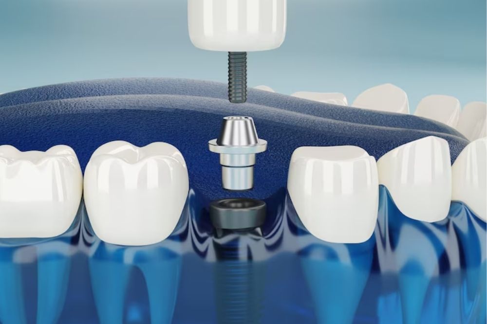 what-is-bone-grafting-and-why-is-it-important-for-dental-implants