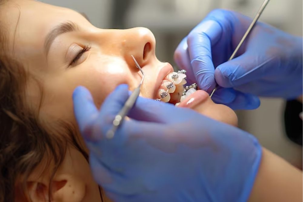 dental bonding