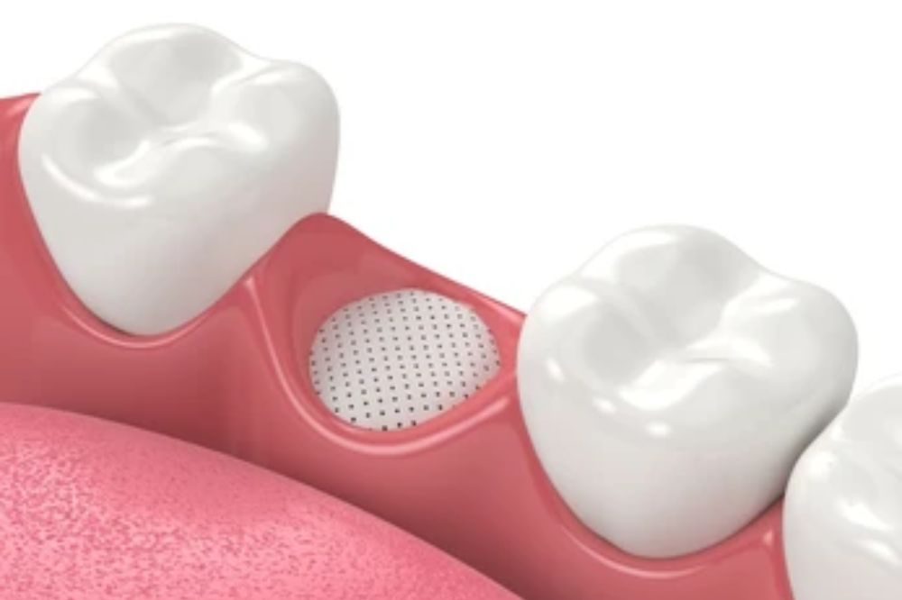 what are the different types of bone grafts, and which one is right for me