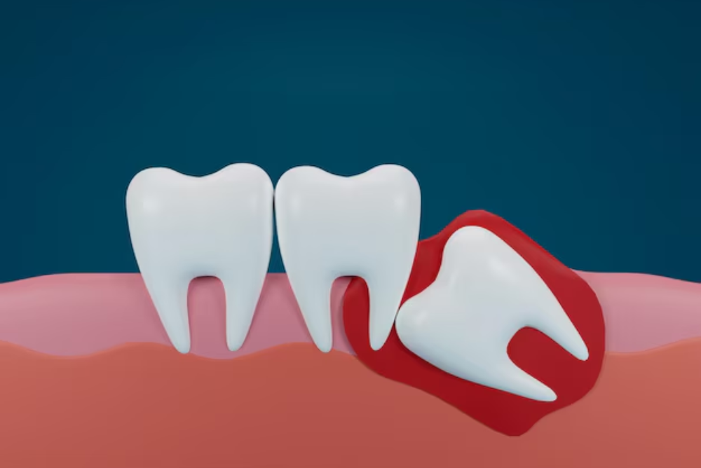 What Happens If You Don't Get Your Wisdom Teeth Removed: Risks and Consequences